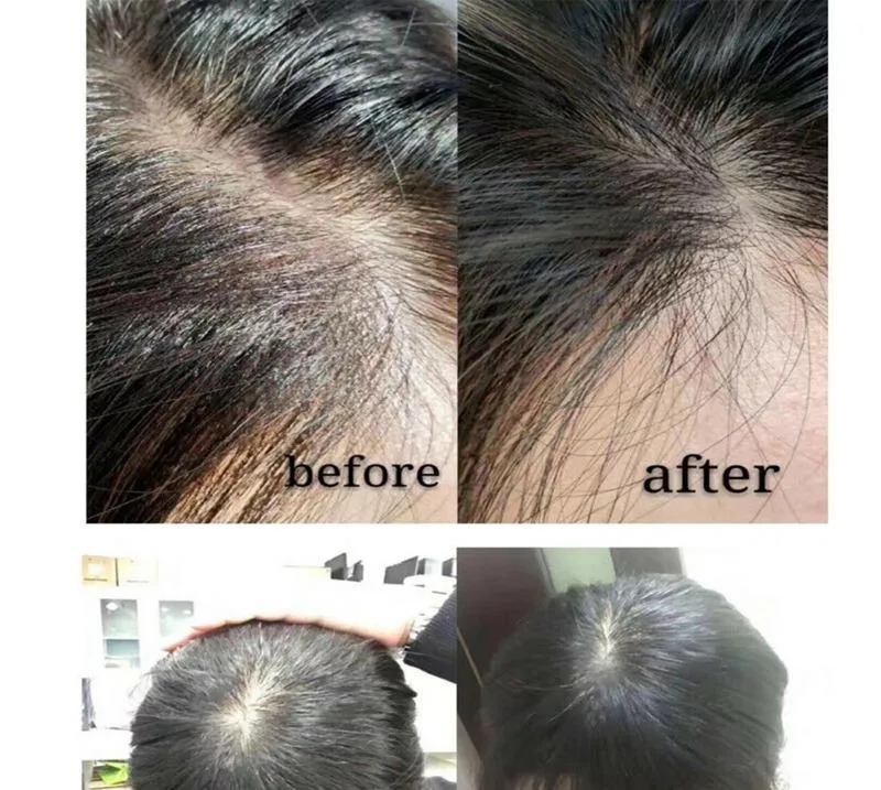 Regenerate Scalp Damagepromotes The Growth of Thicker, Stronger Hair for Dermica® Hairzon - Stylo Mesotherapy/ Dermal Cegaba